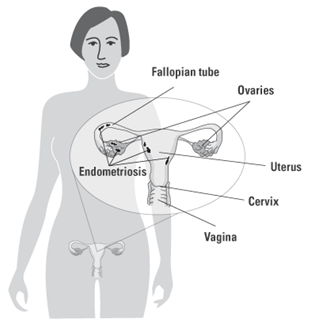 In Endometriosis, the Tissue that Lines the Uterus Begins Growing in Other Female Reproductive Organs (and in Some Cases, Beyond)