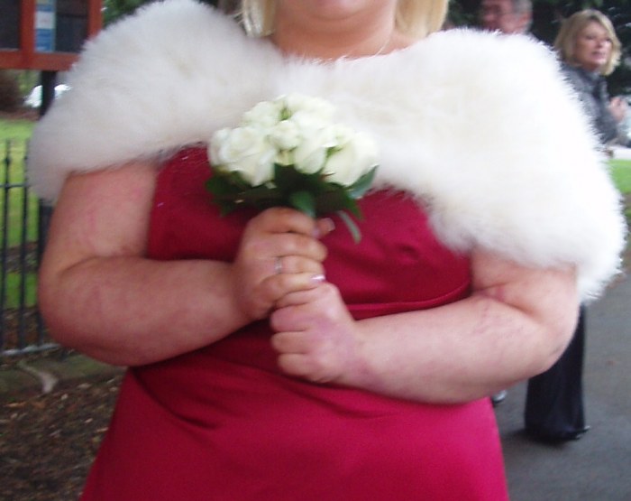 Jessica's Arms During a Psoriasis Flare-up