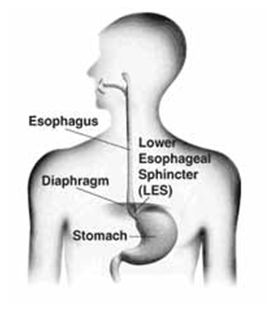 GERD Causes the Backflow or "Reflux" of Stomach Contents, Causing Uncomfortable Symptoms