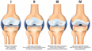 Stages of Osteoarthritis